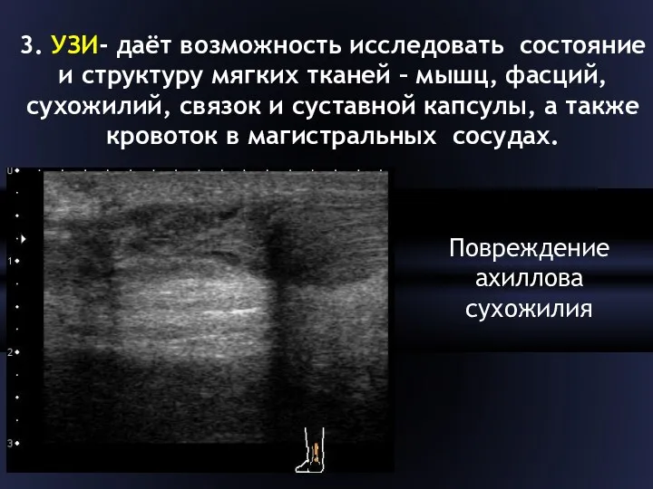 3. УЗИ- даёт возможность исследовать состояние и структуру мягких тканей