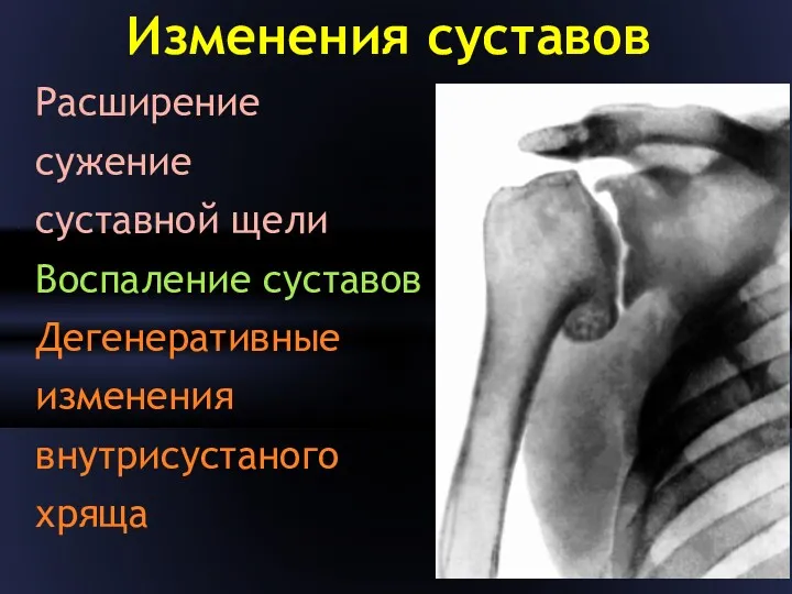 Изменения суставов Расширение сужение суставной щели Воспаление суставов Дегенеративные изменения внутрисустаного хряща