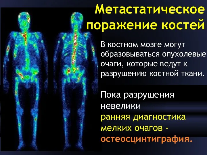 Метастатическое поражение костей В костном мозге могут образовываться опухолевые очаги,