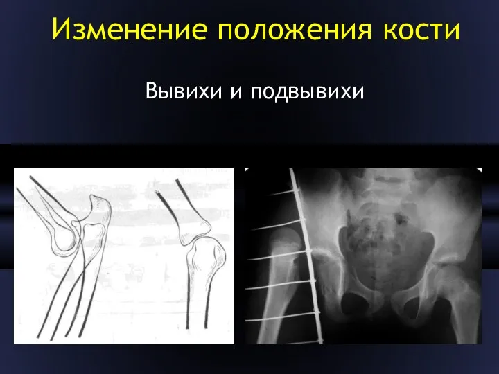 Изменение положения кости Вывихи и подвывихи