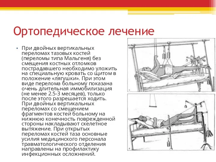 Ортопедическое лечение При двойных вертикальных переломах тазовых костей (переломы типа