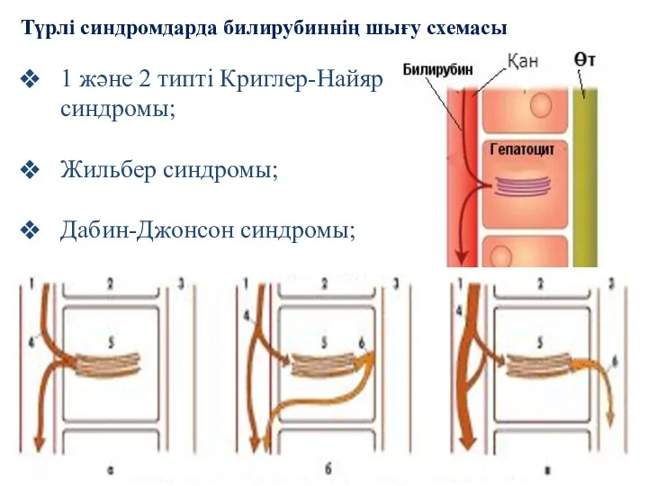 Түрлі синдромдарда билирубиннің шығу схемасы 1 және 2 типті Криглер-Найяр синдромы; Жильбер синдромы; Дабин-Джонсон синдромы;