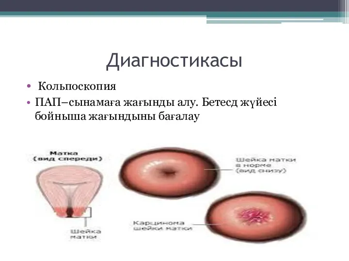 Диагностикасы Кольпоскопия ПАП–сынамаға жағынды алу. Бетесд жүйесі бойныша жағындыны бағалау