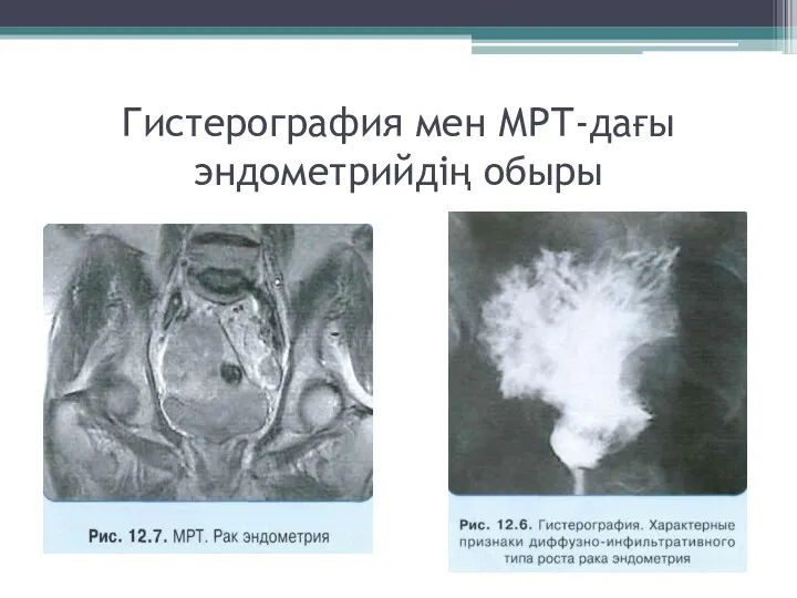 Гистерография мен МРТ-дағы эндометрийдің обыры