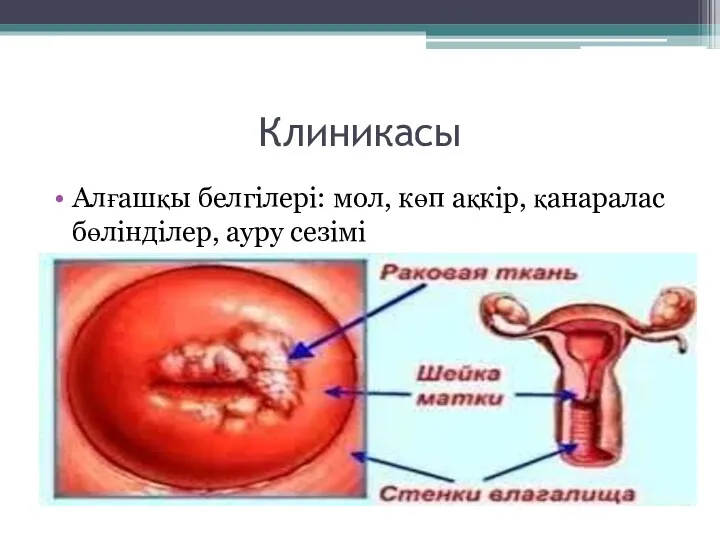 Клиникасы Алғашқы белгілері: мол, көп ақкір, қанаралас бөлінділер, ауру сезімі