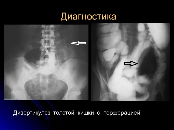 Диагностика Дивертикулез толстой кишки с перфорацией