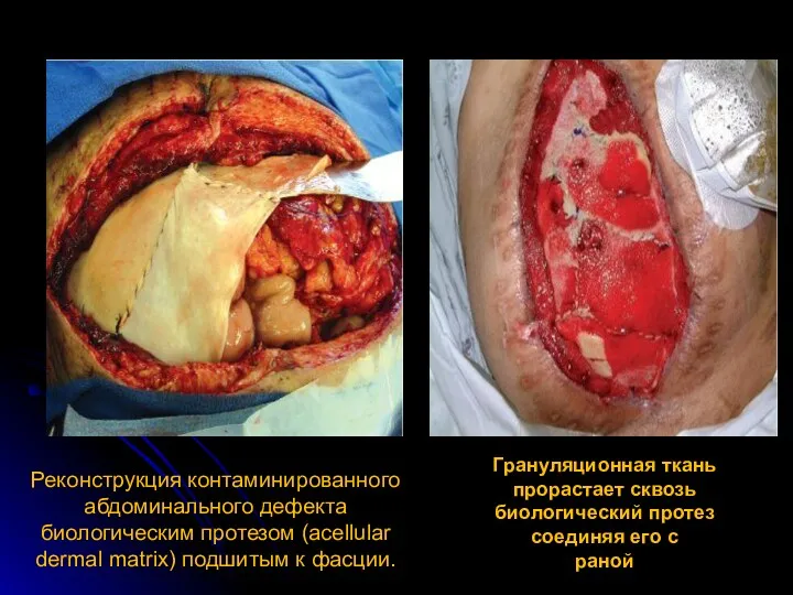 Реконструкция контаминированного абдоминального дефекта биологическим протезом (acellular dermal matrix) подшитым
