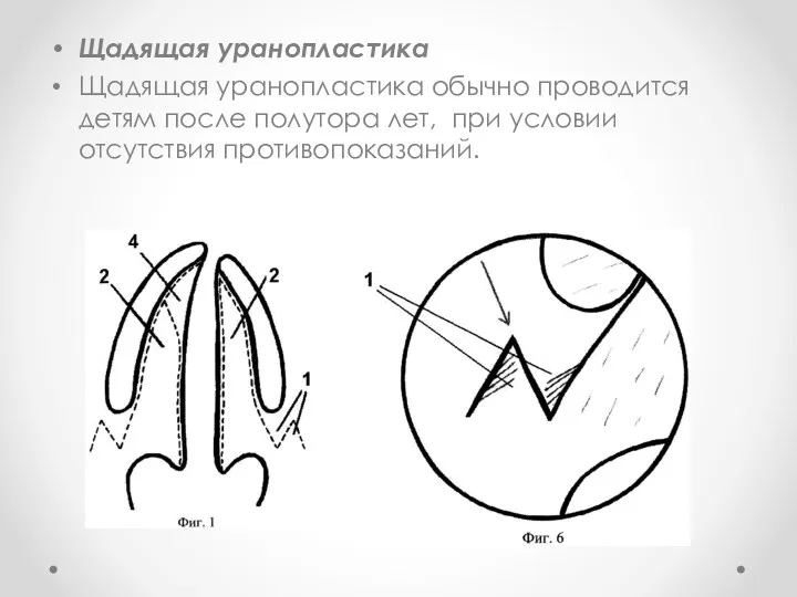 Щадящая уранопластика Щадящая уранопластика обычно проводится детям после полутора лет, при условии отсутствия противопоказаний.