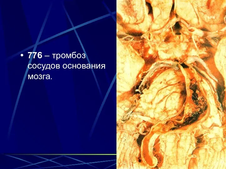 776 – тромбоз сосудов основания мозга.