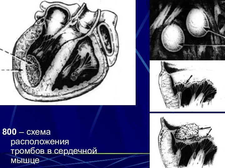 800 – схема расположения тромбов в сердечной мышце