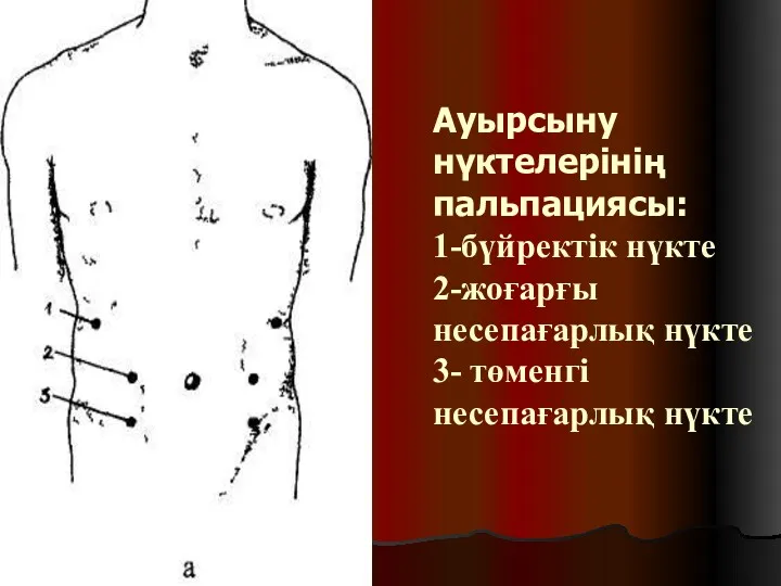 Ауырсыну нүктелерінің пальпациясы: 1-бүйректік нүкте 2-жоғарғы несепағарлық нүкте 3- төменгі несепағарлық нүкте