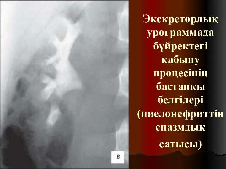 Экскреторлық урограммада бүйректегі қабыну процесінің бастапқы белгілері (пиелонефриттің спазмдық сатысы)