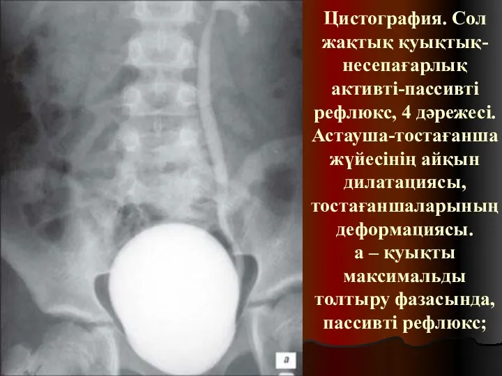 Цистография. Сол жақтық қуықтық-несепағарлық активті-пассивті рефлюкс, 4 дәрежесі. Астауша-тостағанша жүйесінің