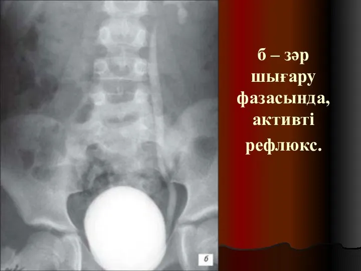 б – зәр шығару фазасында, активті рефлюкс.