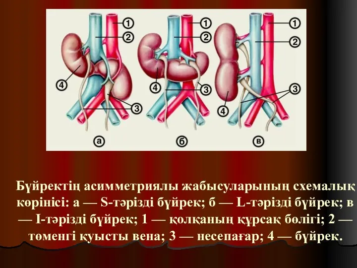 Бүйректің асимметриялы жабысуларының схемалық көрінісі: а — S-тәрізді бүйрек; б