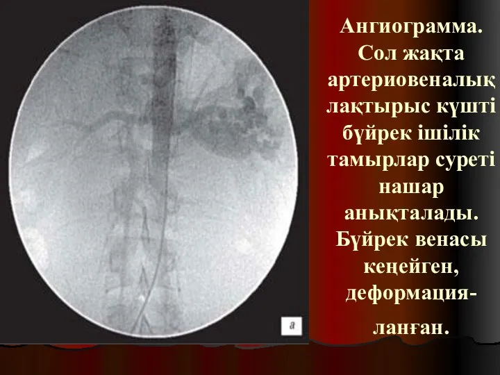 Ангиограмма. Сол жақта артериовеналық лақтырыс күшті бүйрек ішілік тамырлар суреті нашар анықталады. Бүйрек венасы кеңейген, деформация-ланған.