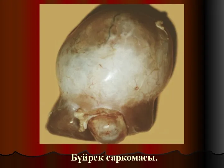 Бүйрек саркомасы.