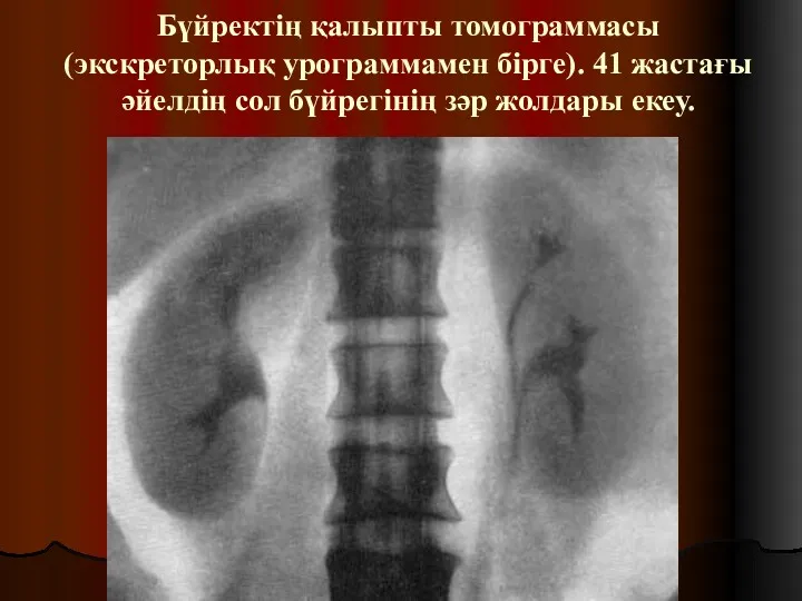 Бүйректің қалыпты томограммасы (экскреторлық урограммамен бірге). 41 жастағы әйелдің сол бүйрегінің зәр жолдары екеу.