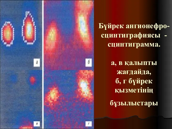 Бүйрек ангионефро-сцинтиграфиясы - сцинтиграмма. а, в қалыпты жағдайда, б, г бүйрек қызметінің бұзылыстары