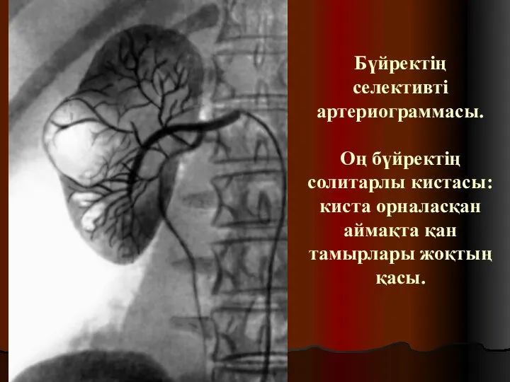 Бүйректің селективті артериограммасы. Оң бүйректің солитарлы кистасы: киста орналасқан аймақта қан тамырлары жоқтың қасы.