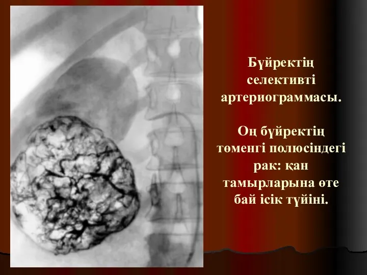 Бүйректің селективті артериограммасы. Оң бүйректің төменгі полюсіндегі рак: қан тамырларына өте бай ісік түйіні.