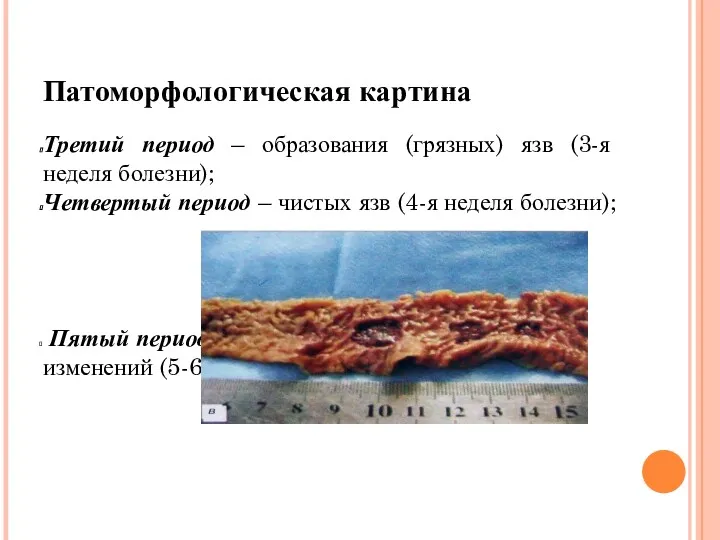 Патоморфологическая картина Третий период – образования (грязных) язв (3-я неделя