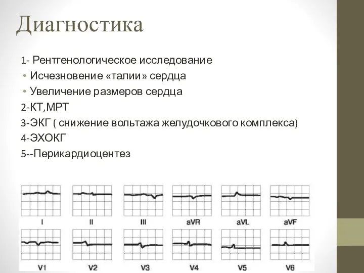 Диагностика 1- Рентгенологическое исследование Исчезновение «талии» сердца Увеличение размеров сердца