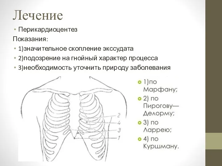 Лечение Перикардиоцентез Показания: 1)значительное скопление экссудата 2)подозрение на гнойный характер процесса 3)необходимость уточнить природу заболевания