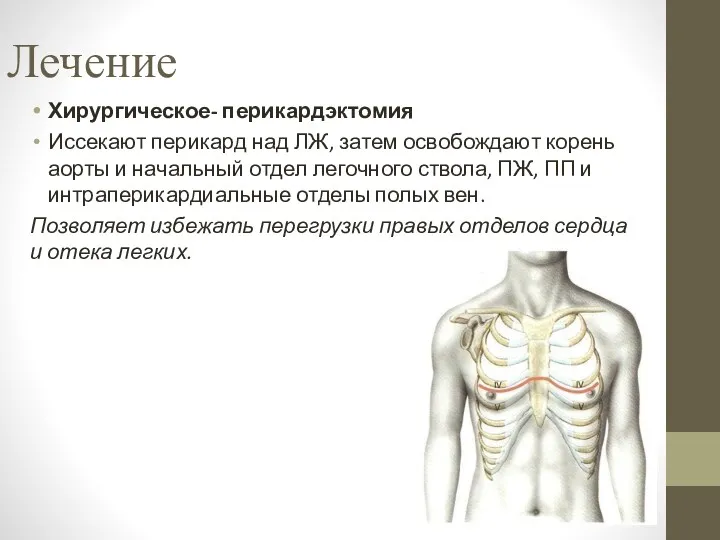 Лечение Хирургическое- перикардэктомия Иссекают перикард над ЛЖ, затем освобождают корень