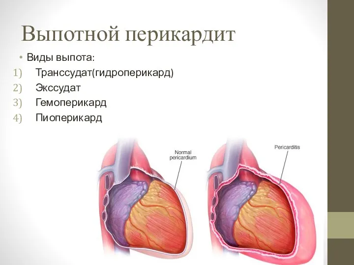 Выпотной перикардит Виды выпота: Транссудат(гидроперикард) Экссудат Гемоперикард Пиоперикард