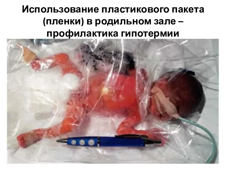 Использование пластикового пакета (пленки) в родильном зале – профилактика гипотермии