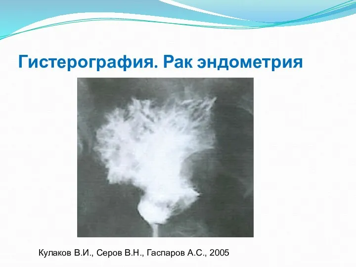 Гистерография. Рак эндометрия Кулаков В.И., Серов В.Н., Гаспаров А.С., 2005