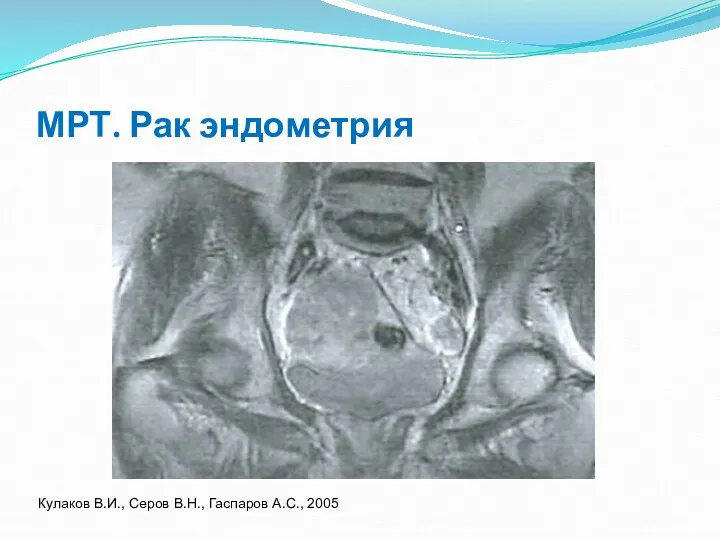МРТ. Рак эндометрия Кулаков В.И., Серов В.Н., Гаспаров А.С., 2005