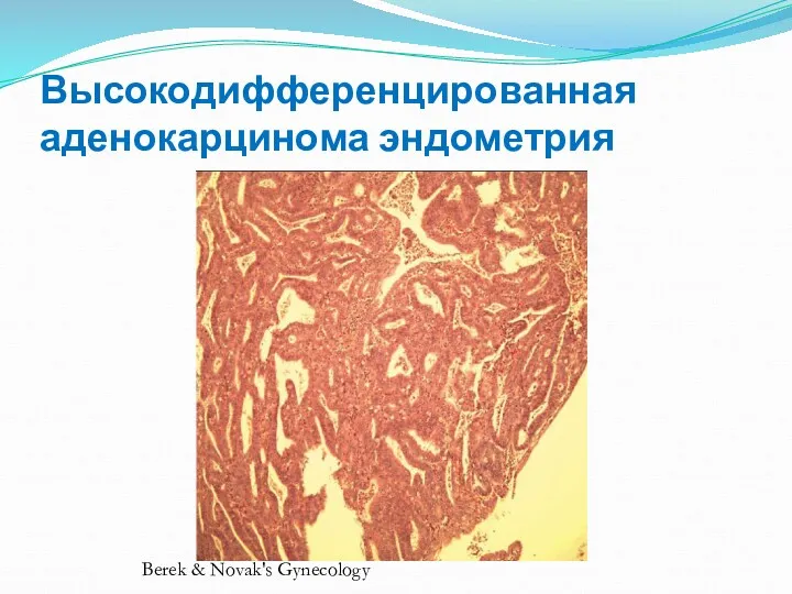 Высокодифференцированная аденокарцинома эндометрия Berek & Novak's Gynecology