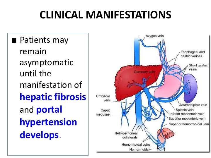 CLINICAL MANIFESTATIONS Patients may remain asymptomatic until the manifestation of hepatic fibrosis and portal hypertension develops.