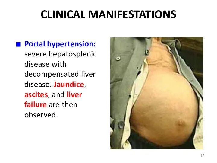 CLINICAL MANIFESTATIONS Portal hypertension: severe hepatosplenic disease with decompensated liver