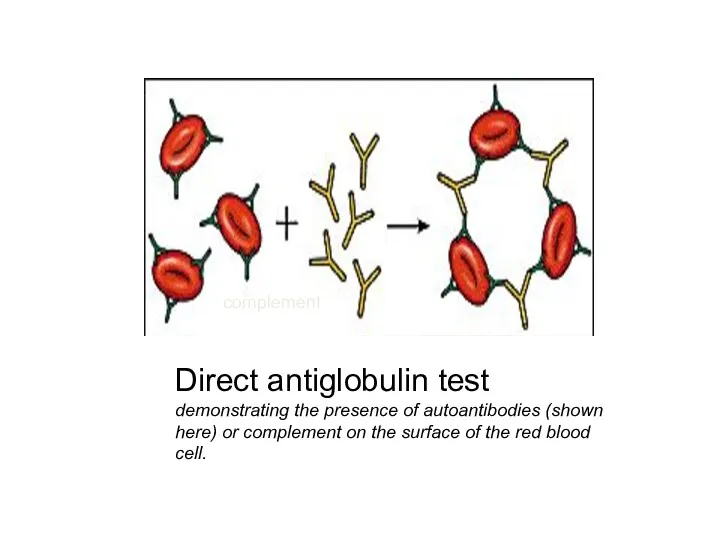 Direct antiglobulin test demonstrating the presence of autoantibodies (shown here)