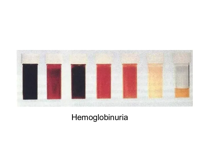 Hemoglobinuria