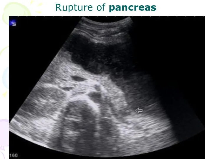 Rupture of pancreas