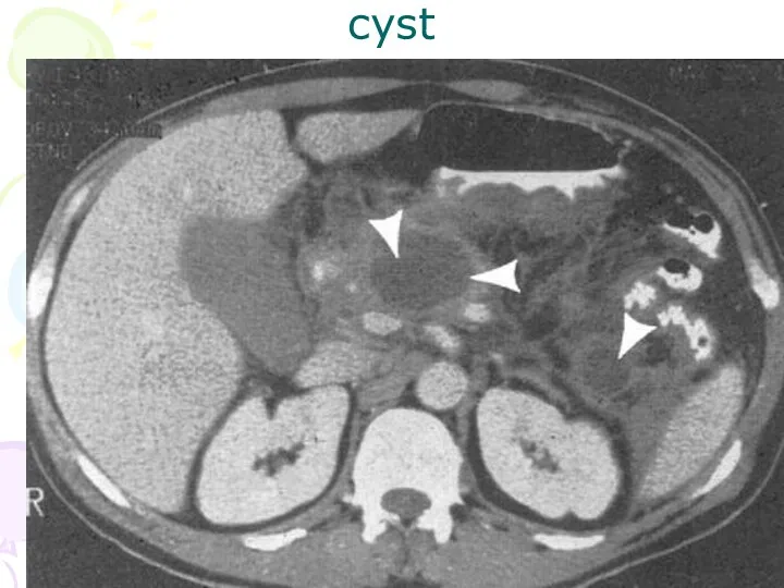 cyst