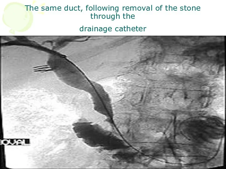 The same duct, following removal of the stone through the drainage catheter