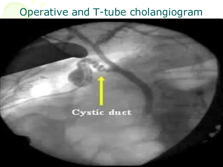 Operative and T-tube cholangiogram