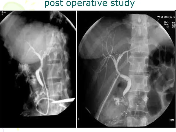 post operative study