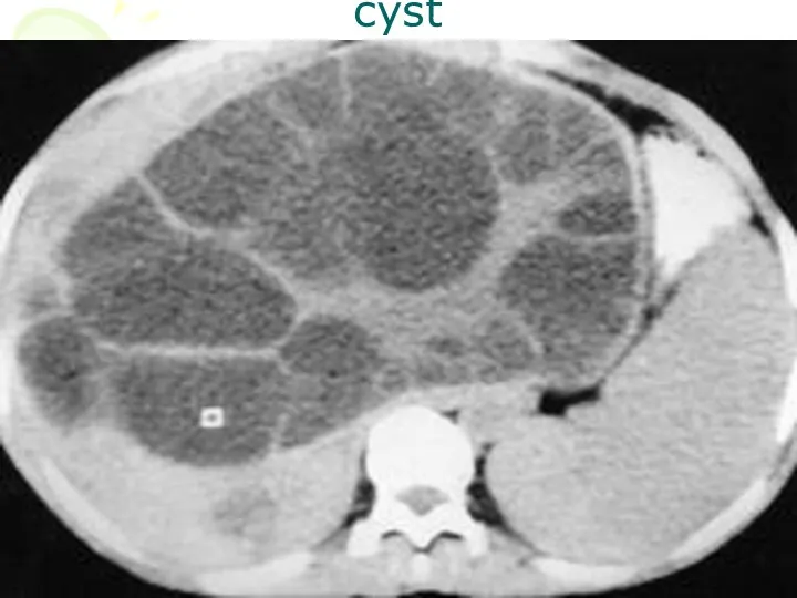 cyst