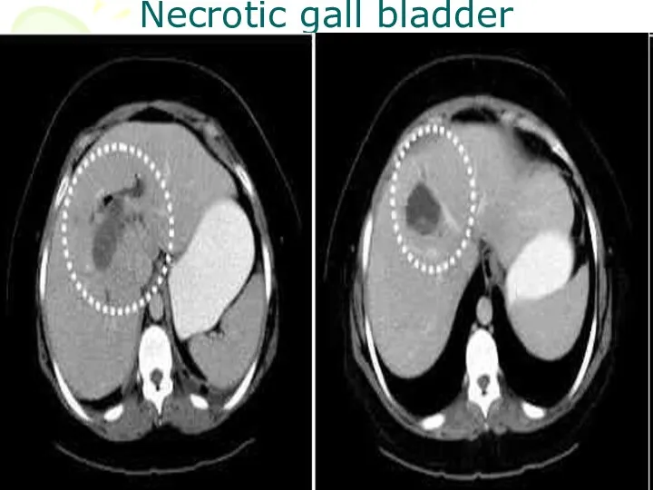 Necrotic gall bladder