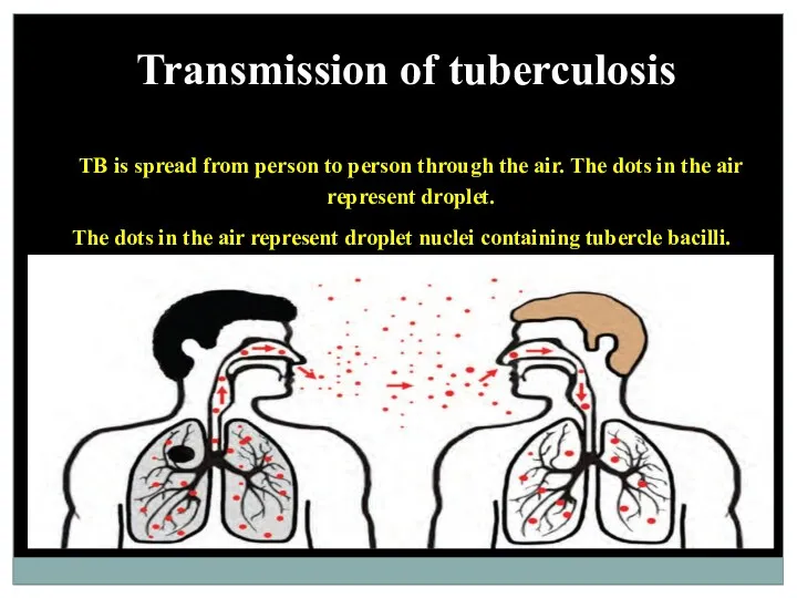 Transmission of tuberculosis TB is spread from person to person
