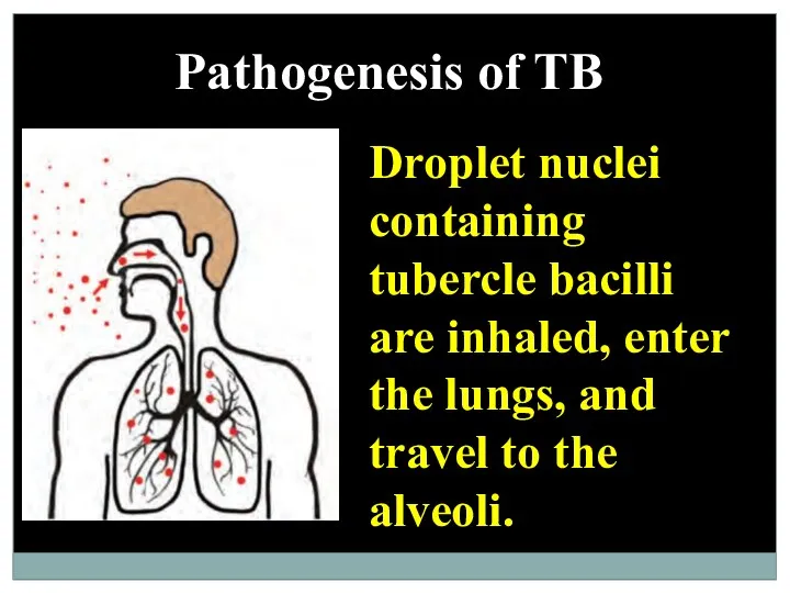 Pathogenesis of TB Droplet nuclei containing tubercle bacilli are inhaled,