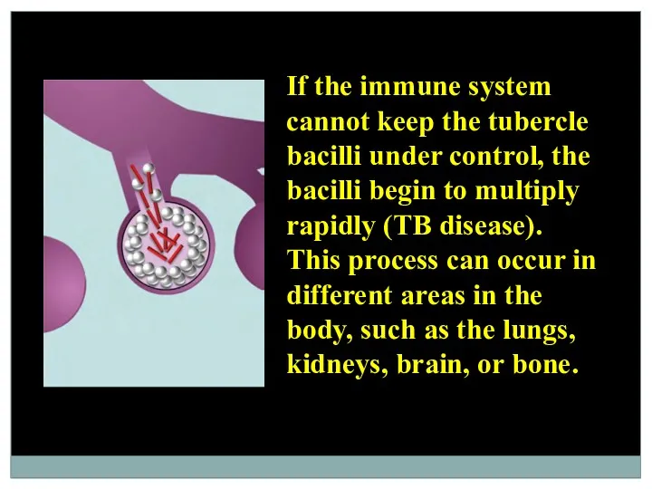 If the immune system cannot keep the tubercle bacilli under