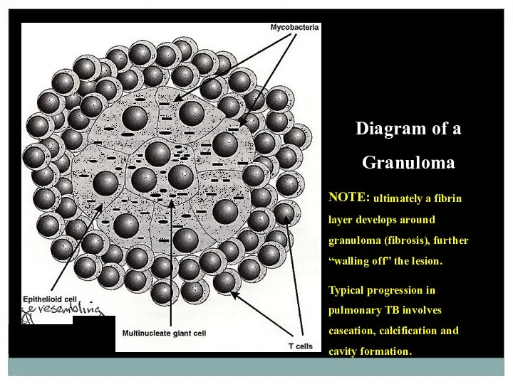 Diagram of a Granuloma NOTE: ultimately a fibrin layer develops