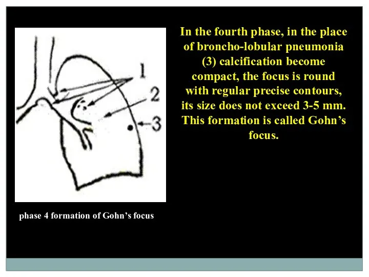 phase 4 formation of Gohn’s focus In the fourth phase,